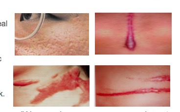 Free Sample of Kelo-Cote Scar Treatment